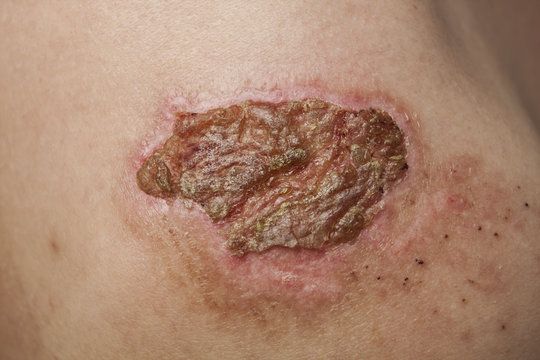 Persona image for Burt Blowbrain